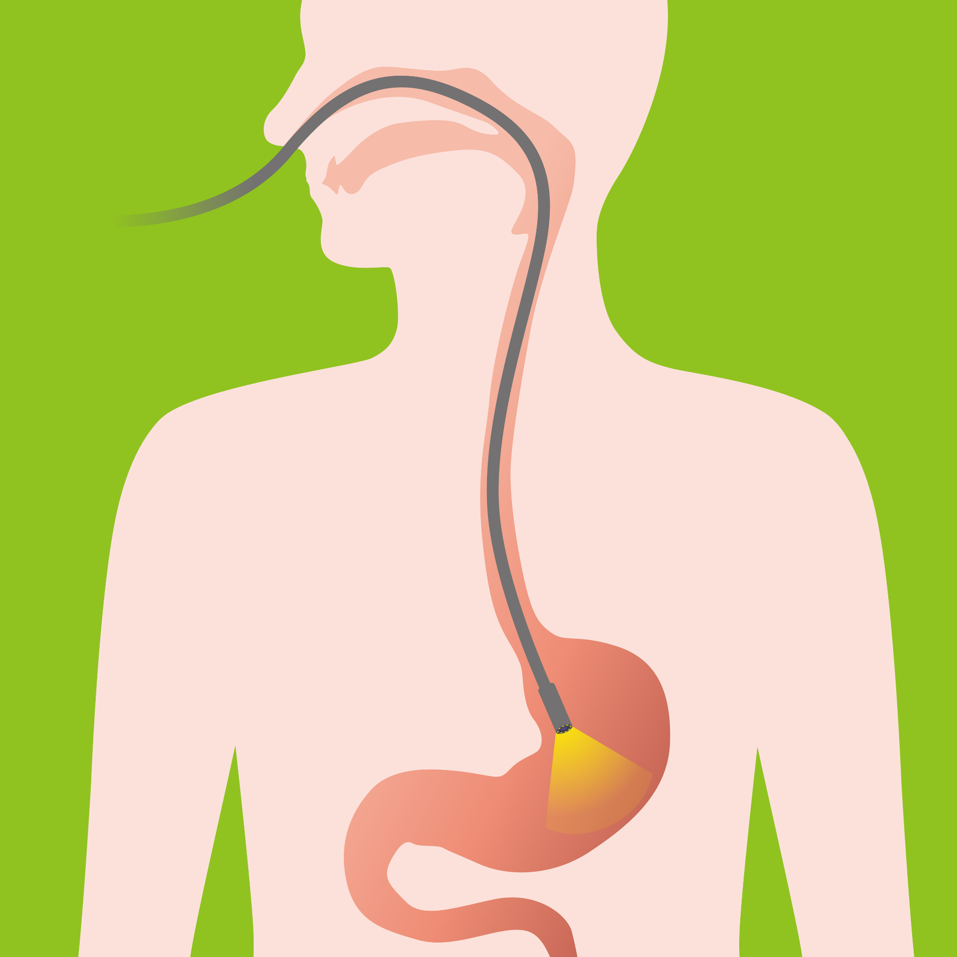 Nasal gastroskopi – kikkertundersøgelse gennem næsen Anatomisk illustration af nasal gastroskopi: ultratyndt skop føres gennem næse og spiserør ned i mavesækken